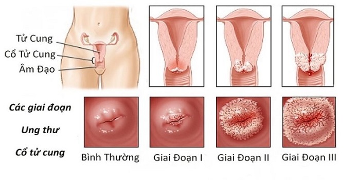 20190901_xet-nghiem-tam-soat-ung-thu-co-tu-cung-1