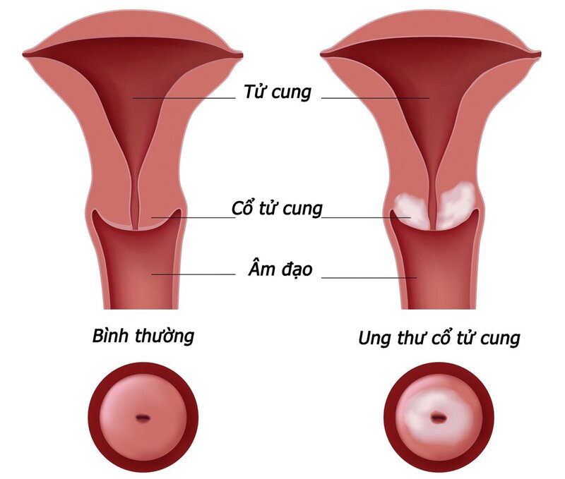 Các loại xét nghiệm ung thư cổ tử cung phổ biến nhất hiện nay
